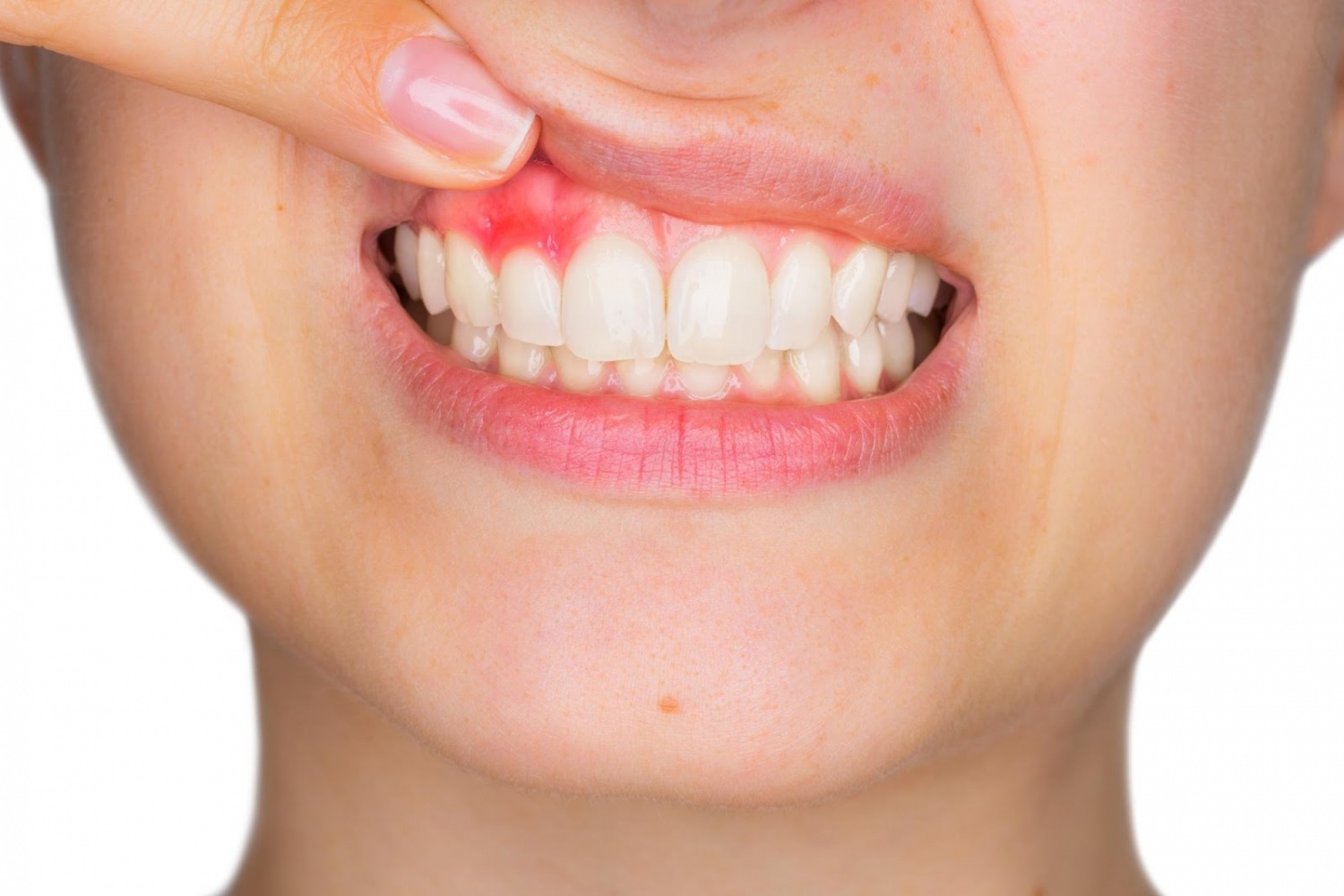 a-guide-on-how-to-stop-bleeding-gums-teen-health-youth-health-magzine